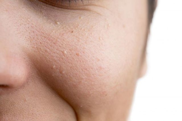 Жировики на лице: как избавиться от проблемы