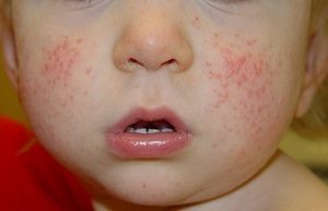 Красные пятна на лице у ребенка: причины, поводы для обследования