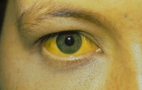 Желтый цвет лица: причины, последствия и способы борьбы с ним