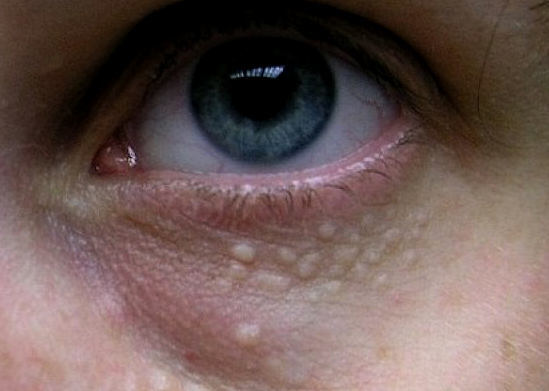 Жировики под глазами: причины и лечение