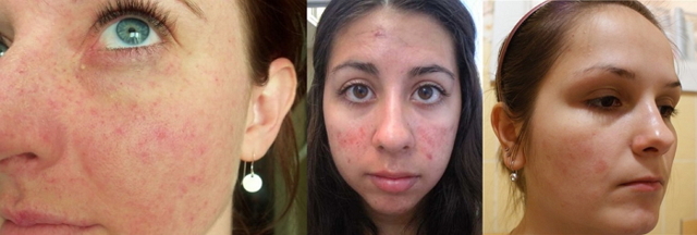 Раздражение на лице в виде красных пятен: причины и лечение