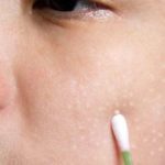 На лице белые пятна: причины и методы избавления