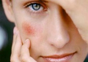 Сухие пятна на лице: причины появления и лечение