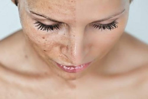 Средства для отбеливания кожи лица в домашних условиях