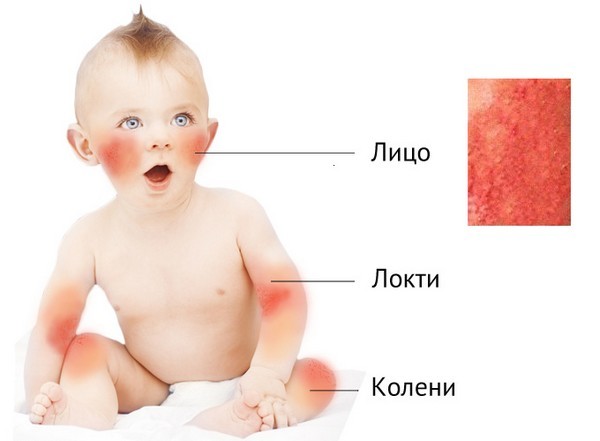 Красные пятна на лице у ребенка: причины, поводы для обследования