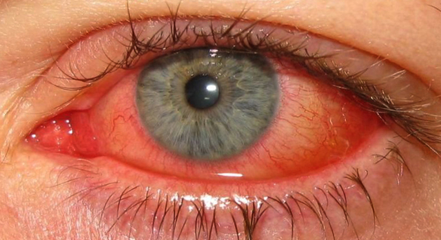 Аллергия на глазах: что к ней приводит и чем лечится