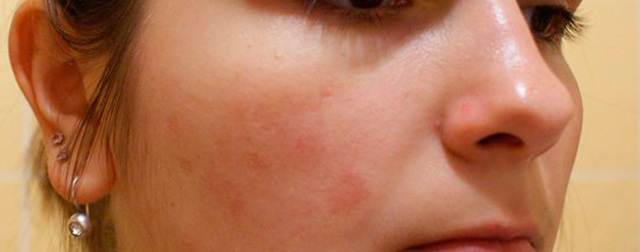 Красные пятна на лице: причины и методы борьбы с ними