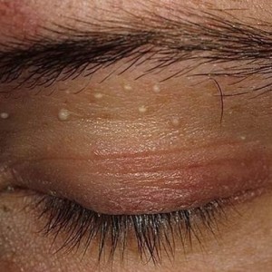 Жировики на лице: способы их удаления и профилактики появления