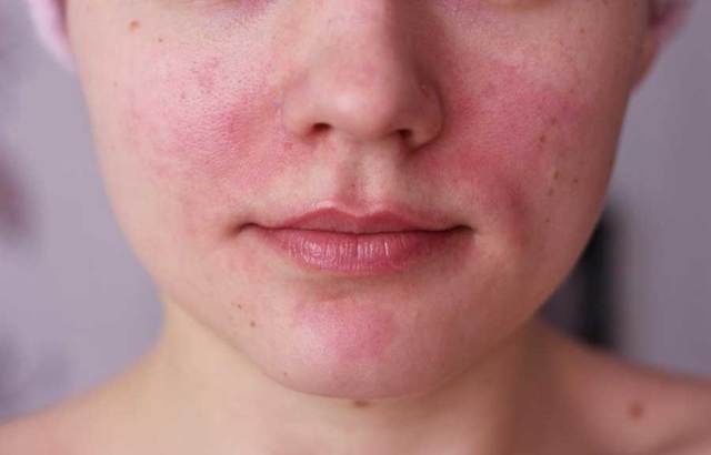 Гиперемия лица: причины покраснения кожных покровов