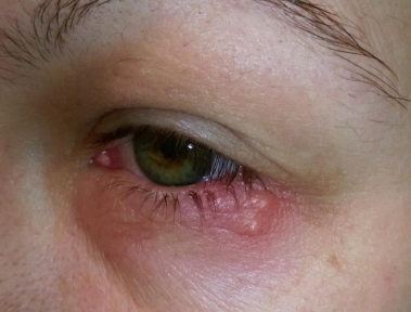 Герпес на глазах: его симптомы и лечение