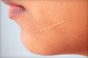 Мазь от рубцов и шрамов на лице: выбираем эффективное средство