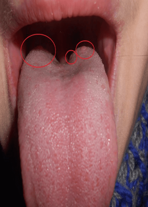 Простудные прыщи на лице: лечение, симптомы и профилактика