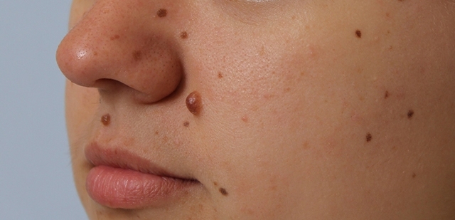 Родимое пятно на лице: можно ли избавиться навсегда