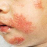 На лице покраснение и шелушится кожа: причины и способы лечения