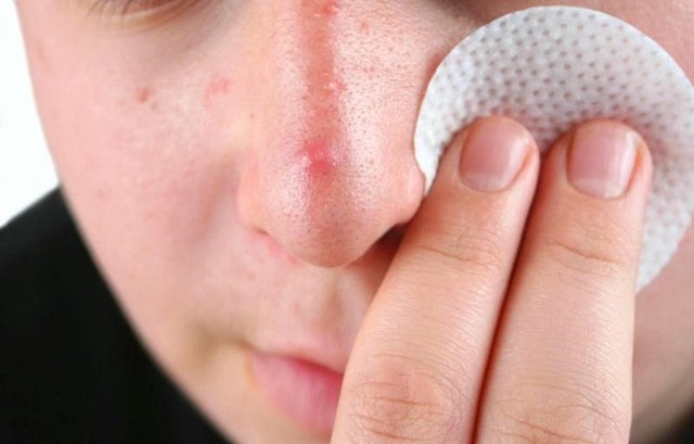 Чем снять воспаление кожи на лице: домашние и аптечные средства
