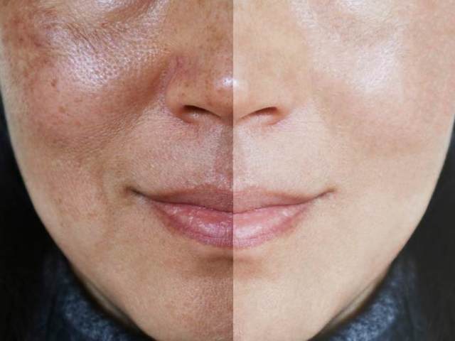 Как сузить поры на лице: рецепты лечебных масок