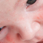 Сыпь на лице у новорожденного 1 месяц: причины и лечение