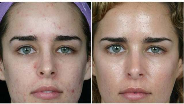 Мануальная чистка лица для красоты и сияния кожи