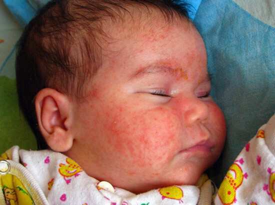 Аллергия на лице у грудничка: причины и способы лечения
