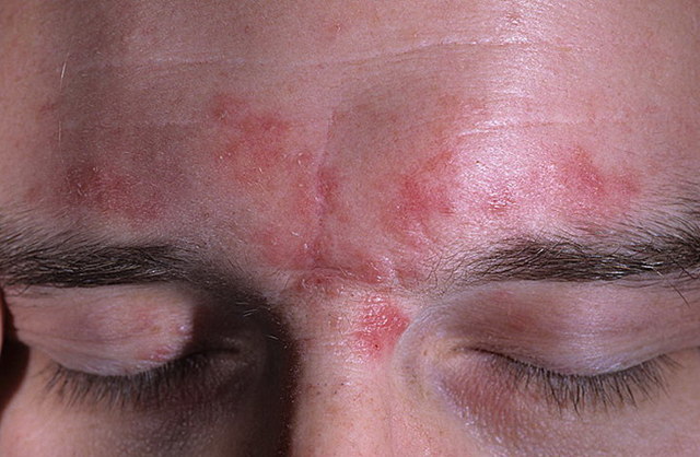 Розацеа на лице: лечение разными методами