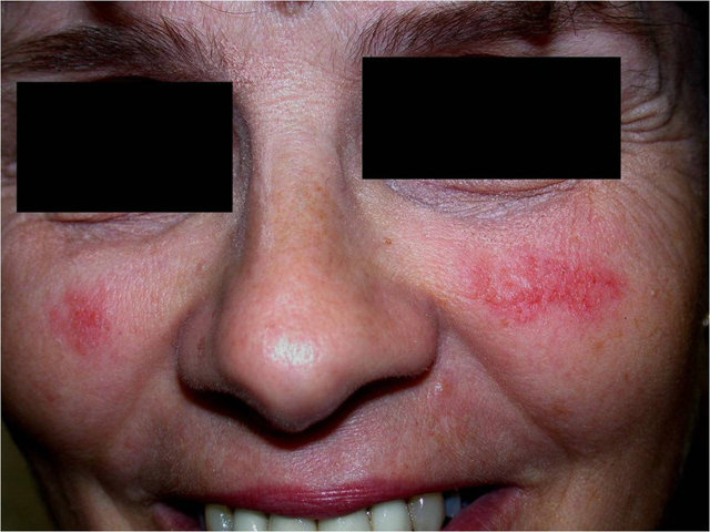 Аллергия на лице: чем лечить и как предупредить