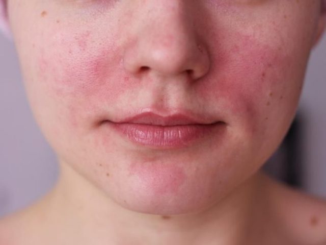 Покраснения на лице: причины косметического дефекта