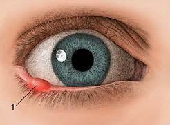 Ячмень на глазу: симптомы, причины и лечение