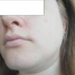 На лице белые пятна: причины и методы избавления
