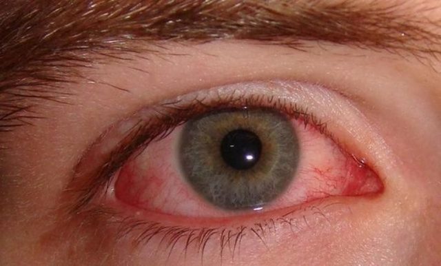 Глазные капли от аллергии: виды и действие