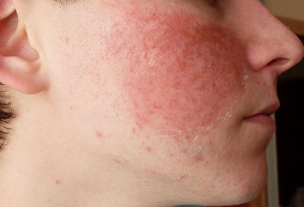 Аллергия на лице - причины появления и методы лечения