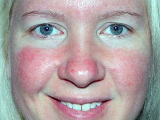 Красное лицо: причины, диагностика, помощь и профилактика