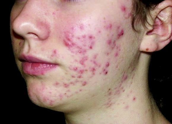 Сыпь на лице у взрослого: причины, типы высыпаний, способы лечения