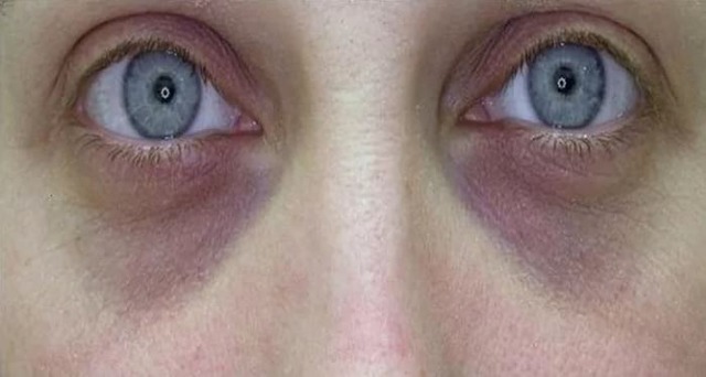 Синяки под глазами: причины у женщин, болезни, домашние маски