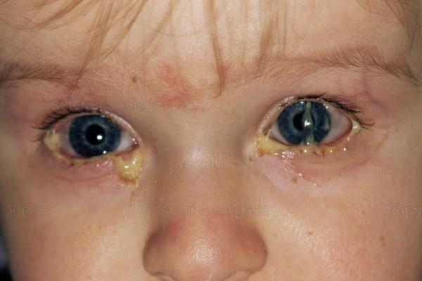 Гнойный конъюнктивит у детей: причины, симптомы, лечение