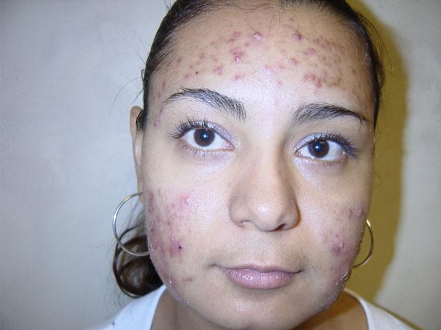 Угревая сыпь на лице: причины и лечение, профилактика