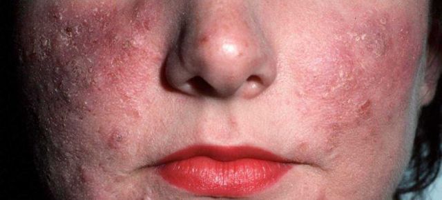 Розацеа на лице: причины, симптоматика и лечение