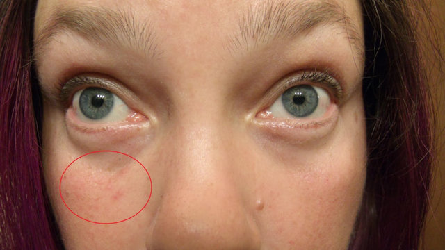 Аллергия на лице: чем лечить и как предупредить