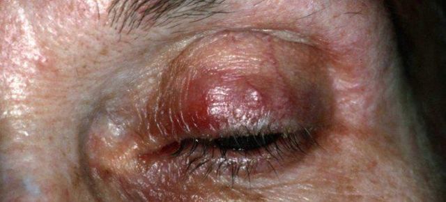 Розацеа на лице: причины, симптоматика и лечение