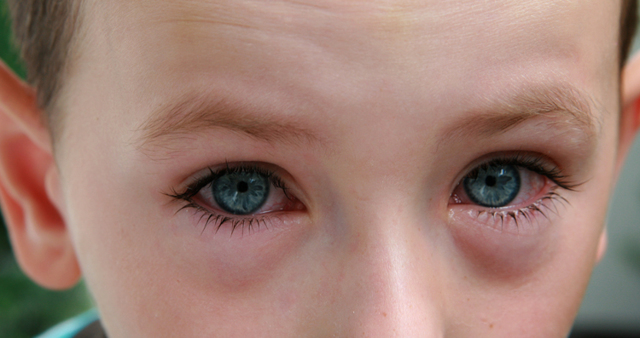 Аллергия на глазах: что к ней приводит и чем лечится