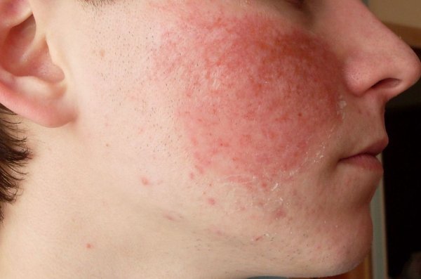 Аллергия на лице - причины появления и методы лечения