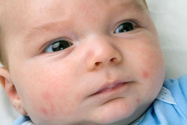 Сыпь на лице у новорожденного 1 месяц: причины и лечение