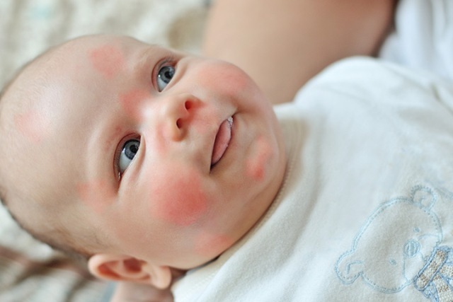 Аллергия на лице у грудничка: причины и способы лечения