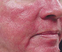 Розовые угри на лице: лечение местное и общее
