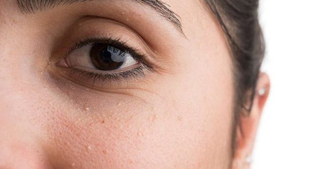 Белые точки на лице: причины появления и способы устранения