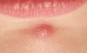 Чем снять воспаление кожи на лице: домашние и аптечные средства