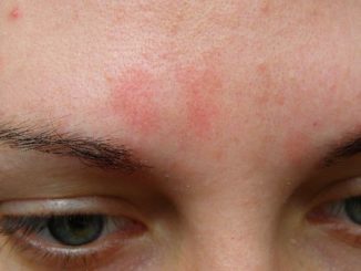 Раздражение на лице в виде красных пятен: причины и лечение