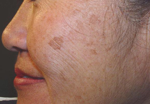 Пятна на лице коричневые: причины и лечение