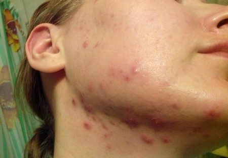 Высыпания на лице у женщин: причины появления, лечение