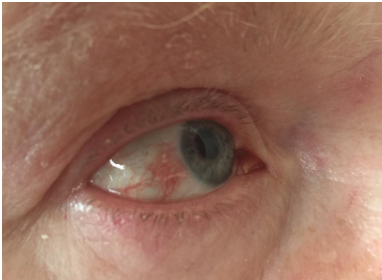 Герпес на глазах: его симптомы и лечение