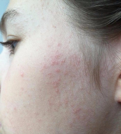 На лице мелкая сыпь: ее причины, лечение и меры профилактики